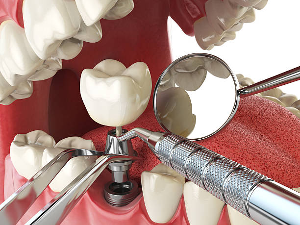 Best Emergency Dentist for Knocked-Out Tooth in Trophy Clu, TX
